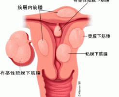 子宮筋腫のリスク